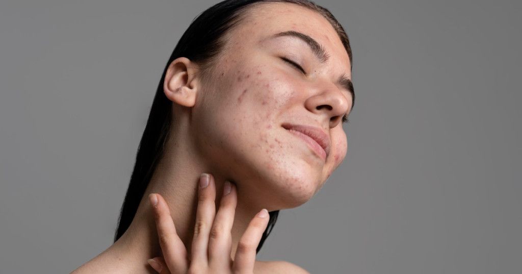 Aloe Vera gegen Couperose: eine natrliche und wirksame Lsung