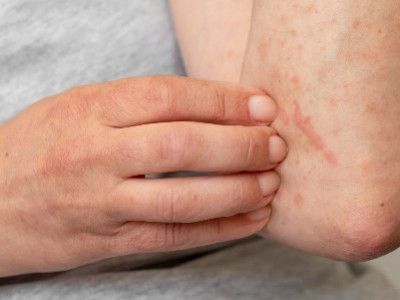 Aloe Vera bei Neurodermitis: Alles, was Sie wissen mssen